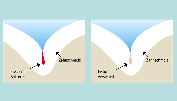 Fissurenversiegelung, Praxis Dr. Nora Makki, Essen Borbeck